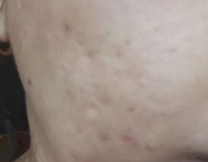 Acne Scares