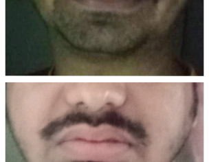 Weakness On Face Cheeks