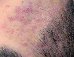 Recommendation For Skin Treatment