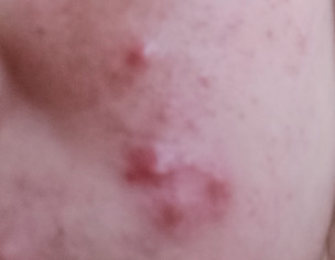 Acne Problem