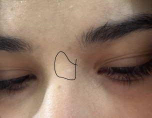 Is This A Vitiligo