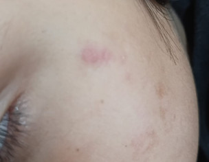Skin Issue