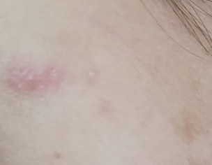 Skin Issue