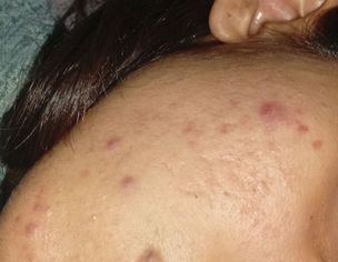 Getting Acne Again And Again And Also Scars