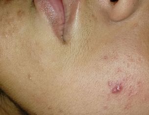 Getting Acne Again And Again And Also Scars