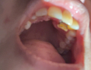 Damaged Teeth