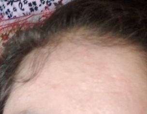 Mery Face Pr Bareek Bareek Dany Allergy Kya Use