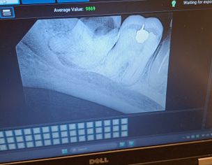 Does A Teeth Cause Muscle Spasm Or Unable To Open Full Mouth?