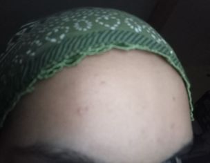 Acne Or Acne Scars