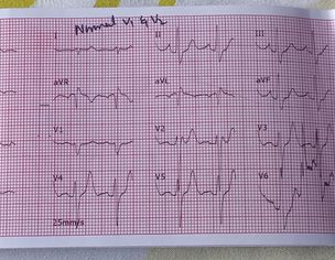 Intermittent Chest And Shoulder Pain