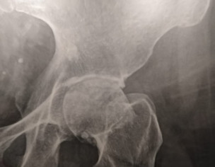 Pain In Backbone 