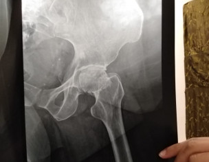 Pain In Backbone 