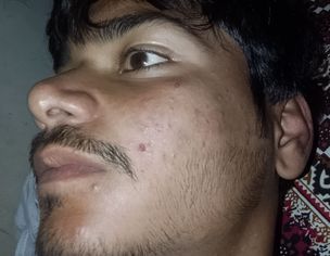 Painful Red Acne On Both Cheeks With Itching For 2 Years