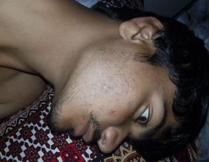 Painful Red Acne On Both Cheeks With Itching For 2 Years