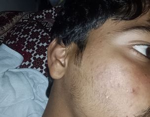 Painful Red Acne On Both Cheeks With Itching For 2 Years