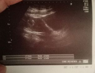 Abortion For Unwanted Pregnency