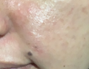 Freckles,pigmentation