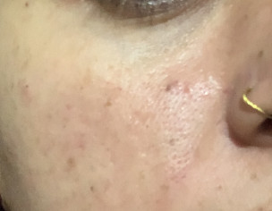 Frackles,pigmentation