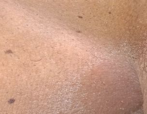 Fungus In Groin Area
