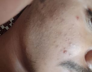 Painful Red Acne On Both Cheeks With Itching For 2 Years