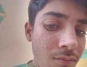 Recurring Pimples And Acne On Face For A Long Time