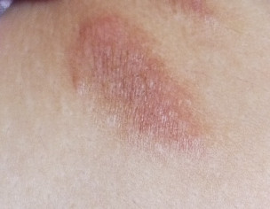 Scabies Scars Related