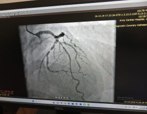 Heart Issue