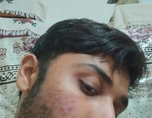 Acne On Face