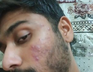 Acne On Face