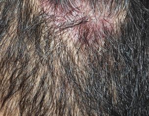 Persistent Dandruff On Scalp And Beard