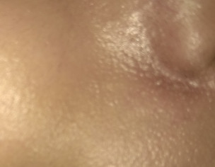 Skin Itching 
