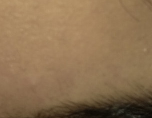 Skin Itching 