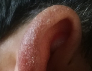 Ichy Ear Lobe Rim