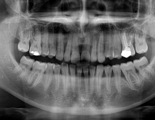Periodontal Disease
