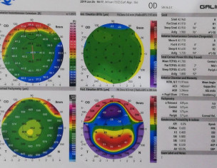 Keratoconus