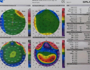 Keratoconus