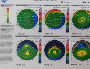 Keratoconus