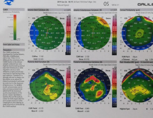 Keratoconus