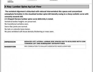 S Curve Scoliosis 