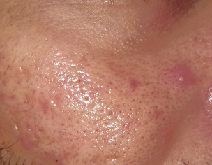 Acne, Acne Scars, Redness Around The Nose