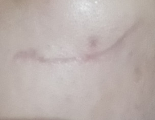 Stitches On Cheeks