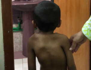 Scoliosis 