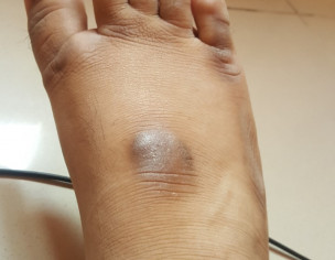 Black Mark On My Feet