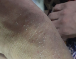 Skin Problem