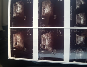 Nil Sperm, High FSH And Cyst