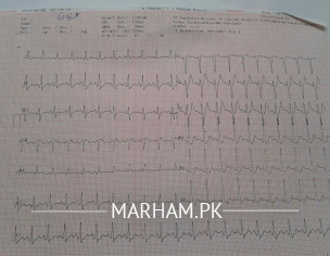 Chest Pressure Left Side