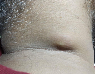  Neck Abscess May Be