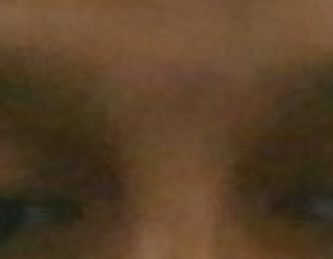 Droppy Eyelid
