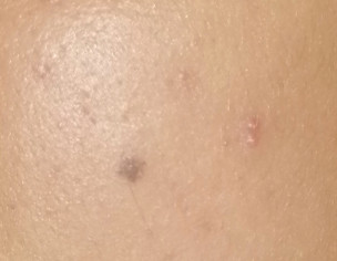 Acne Scars And Open Pores