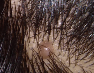 Scalp Mole